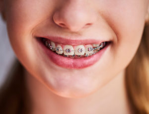 Orthodontic Treatment Options