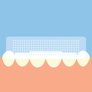 Over-the-counter Teeth Whitening Kits