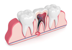 What is a dental cyst?