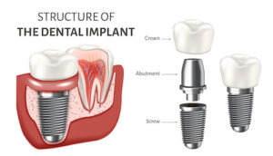 Discover the Many Reasons that Dental Implants May Be Worth the Investment