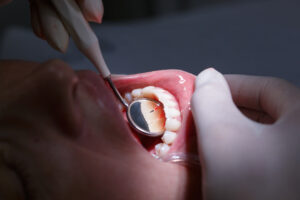 Are Receding Gums Something to Worry About? Get the Facts from a California Dentist 