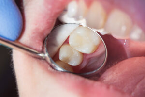 Composite Fillings Provide a Nearly Invisible Filling as Part of Cosmetic Dentistry Advancements