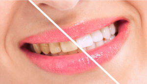 Learn What to Do if You Are Tired of Having Yellowed or Discolored Teeth 