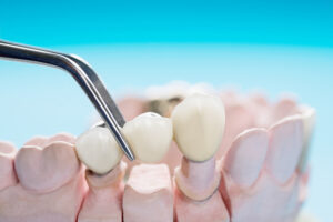 Dental Bridges: What Are They and Will They Work Well for Your Needs?