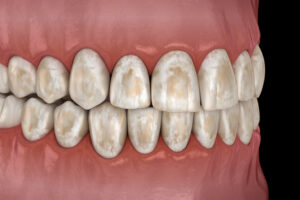 Clearing Up the Confusion: Can Tooth Enamel Be Saved or Repaired? 