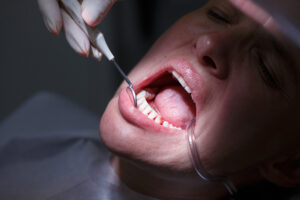 Do Bleeding Gums Always Indicate Gum Disease? No – But They Usually Do