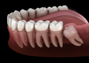 The Facts About Wisdom Teeth: Do You Really Need to Get Them Removed? 