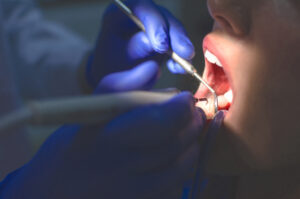 Learn the Four Steps from Plaque to Periodontitis – and How You Can Prevent Gum Disease