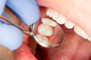 Post-Root Canal Procedures That Can Make Your Teeth Look Better Than Ever