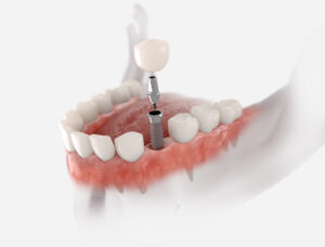 Are You Considering Dental Implants? Check Out the Typical Timeline for the Various Steps Involved 