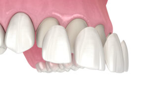 Are You Interested in Porcelain Veneers? Learn What to Expect at Each Stage of the Dental Process 