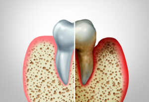 Are You Worried You Have Gum Disease? Learn Some of the Symptoms of This Preventable Disease 