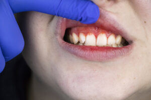 Are You Dealing with Bleeding Gums? Learn Some of the Most Common Causes 