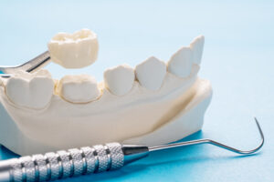 Everything You Need to Know About Dental Crowns