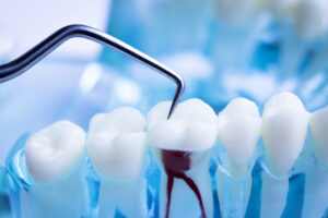 The Truth about Root Canals: Are They as Painful as People Imagine Them to Be? 