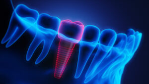 Dental Implants Can Help Prevent Bone Loss and Keep Your Jaw Stronger