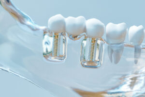 Get the Facts About Different Types of Dental Implants and Decide Which One is Best for You