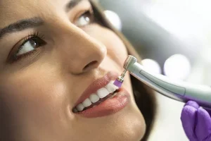 Get the Facts about Teeth Polishing: What is It and is It Right for You?
