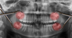 We Have Answers to the Most Common Questions About Wisdom Teeth
