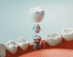 It is Normal to Have Questions About Dental Implants – Let Us Answer Them for You