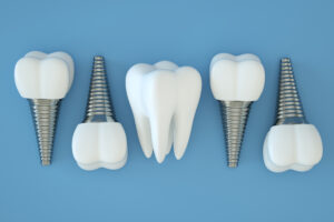Dental Implants Are a Great Choice for a Variety of Patients – Get the Facts Today