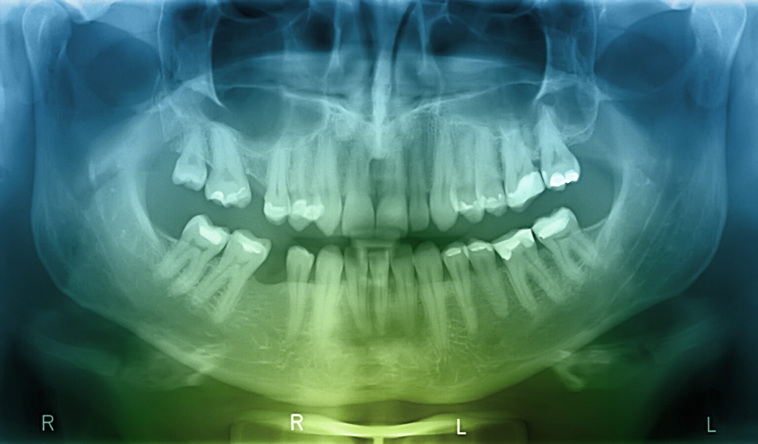 Dental XRays Can Be Helpful to Your Dentist in Ways You Might Not Have