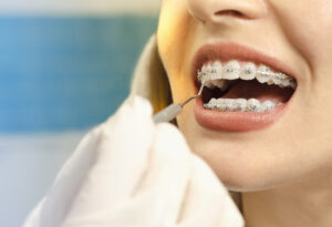 Do You Have Questions About Braces for Adults? Get the Answers You Need Today 