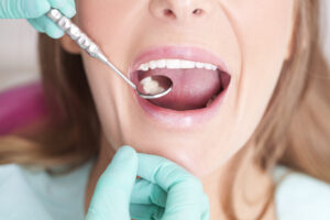 Get Answers to Common Questions About Cavities and How They Can Be Most Effectively Treated