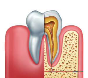 Get the Answers You Need to Questions About Root Canal Therapy