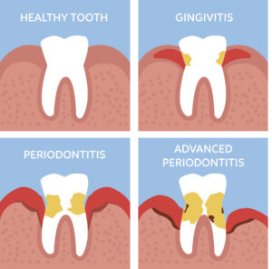 Learn the Core Causes of Gingivitis and How Your Dentist Can Help You Prevent It
