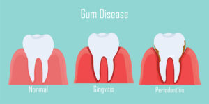 Do You Have Questions About Gum Disease? Get Answers from Your Local Dentist 