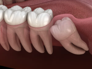 Having Your Wisdom Teeth Removed Can Solve Some Issues and Prevent Others