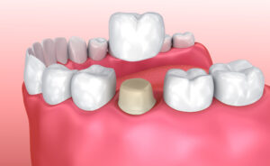 Learn Some of the Most Compelling Reasons You Should Consider a Dental Crown