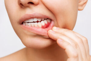 Do You Have Puffy Gums? Learn About At-Home Treatments That Can Help 