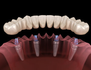 Four Important Facts to Know About Dental Implants Before Deciding to Get Them 