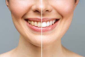 Find the Answers You Seek to Questions About Teeth Whitening from a Southern California Dentist