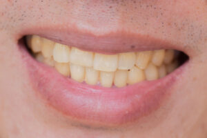 There Are Many Options to Help with Stained Teeth: Learn About the Latest in Cosmetic Dentistry