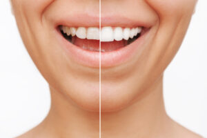 We Will Consider Many Factors When Determining the Best Material for Your Veneers