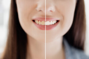 Whitening Your Teeth When You Have Oral Health Issues: Is it Safe and Effective?