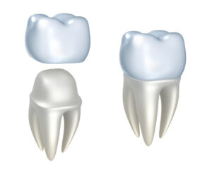 5 Reasons Dental Crowns Might Be the Right Solution to Your Broken or Damaged Teeth