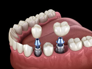 Learn the Basics About the Main Types of Dental Implants Available in 2023