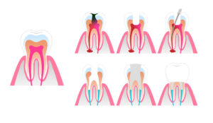 Root canal treatment is necessary when bacteria enter the root of the tooth and cause pus or pain.