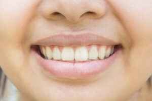 Yellow teeth with smile in teen and face