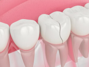 3d render of jaw with treatable cracked tooth over white background. Types of broken teeth concept.