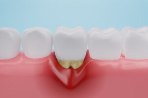 Gum disease, Gingival Recession or inflammation for dental clinic and treatment. 3D rendering.