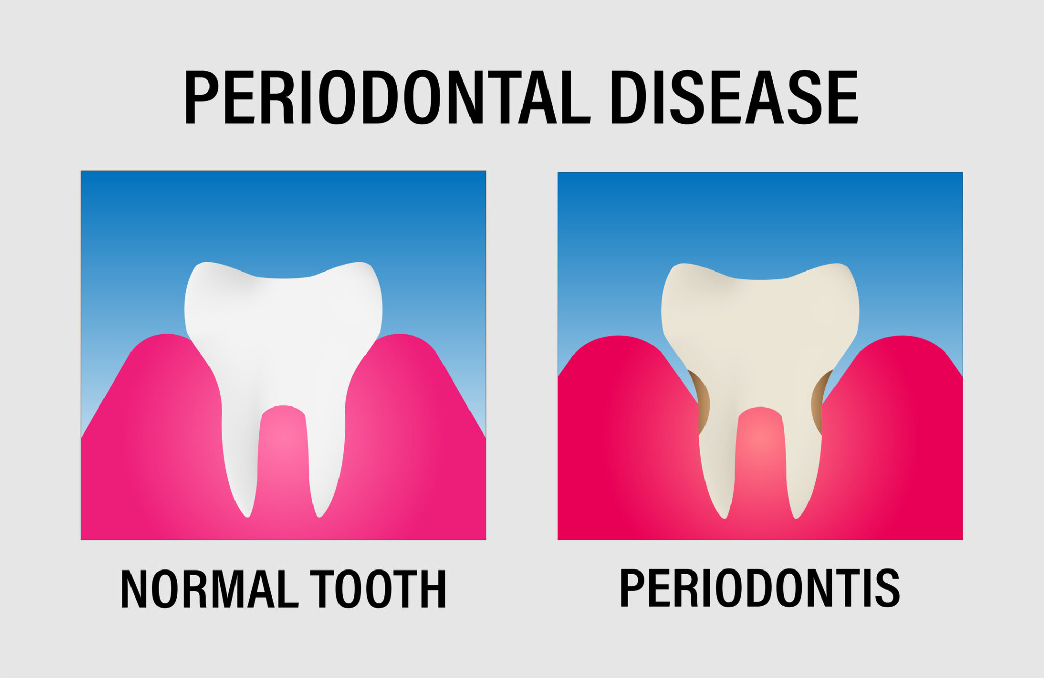 Gingivitis vs Periodontitis Understanding the Differences and