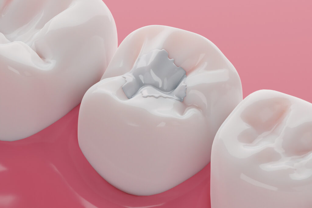 Get Answers to the Three Most Common Questions About Cavities and How ...