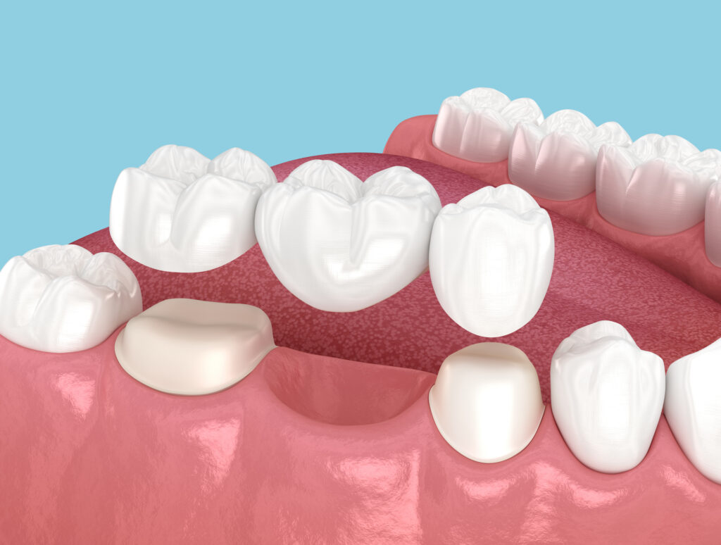 Protecting Your Investment: How to Prevent Gum Disease Around Your Dental Bridge