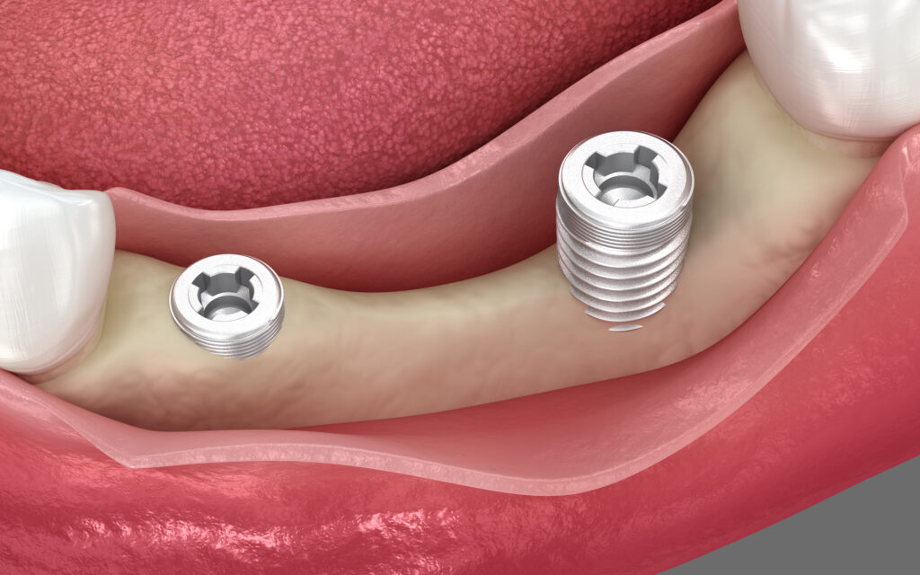 Breaking Down Dental Implants: What Are the Key Parts and Why Do They Matter?