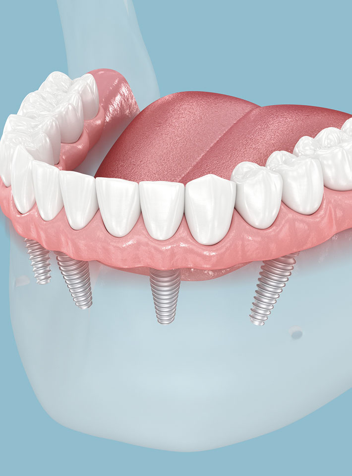 Dental Implants